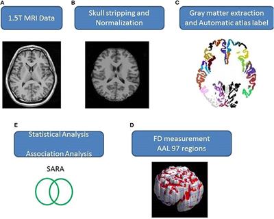 Supratentorial and Infratentorial Lesions in Spinocerebellar Ataxia Type 3